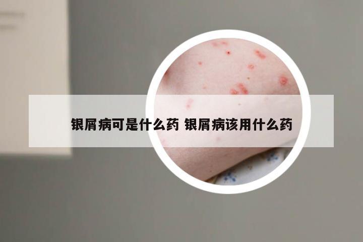 银屑病可是什么药 银屑病该用什么药