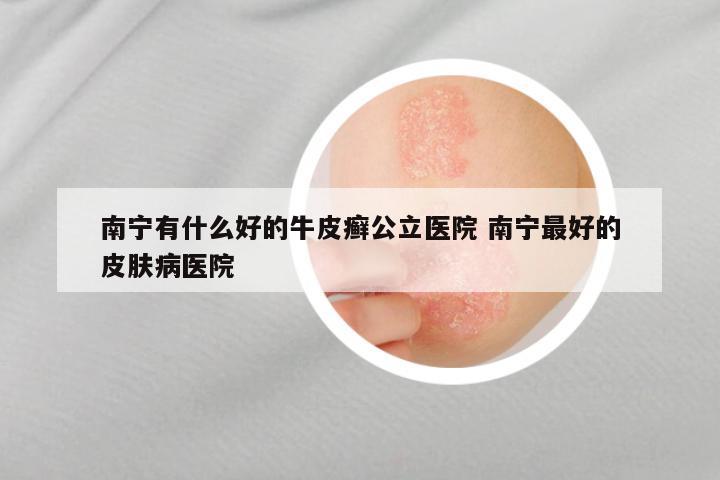 南宁有什么好的牛皮癣公立医院 南宁最好的皮肤病医院