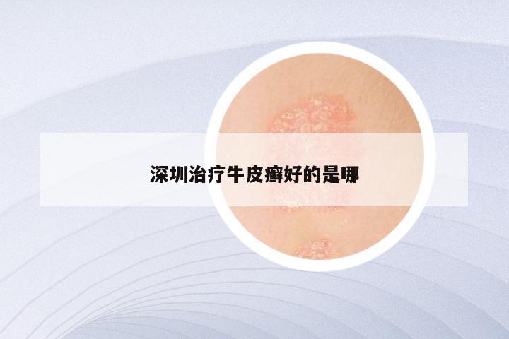 深圳治疗牛皮癣好的是哪