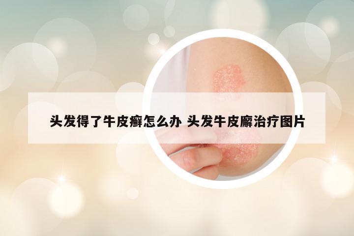 头发得了牛皮癣怎么办 头发牛皮廨治疗图片