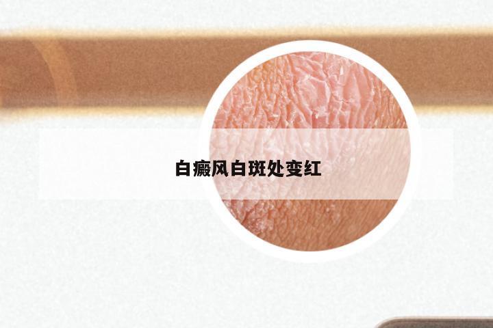 白癜风白斑处变红