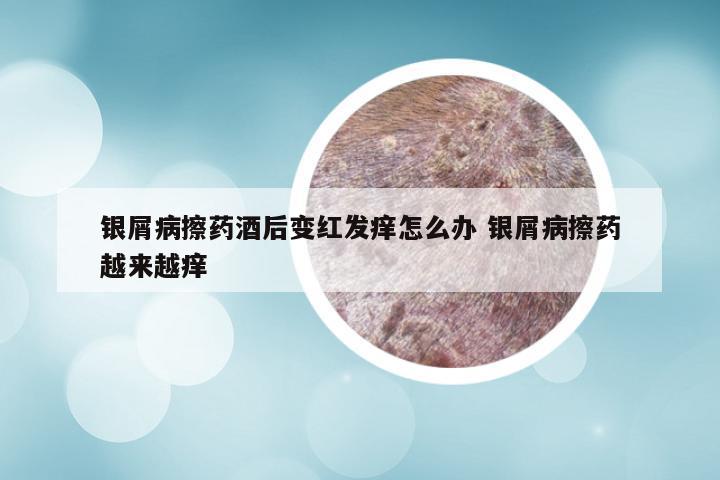 银屑病擦药酒后变红发痒怎么办 银屑病擦药越来越痒