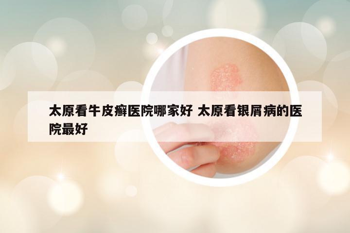 太原看牛皮癣医院哪家好 太原看银屑病的医院最好