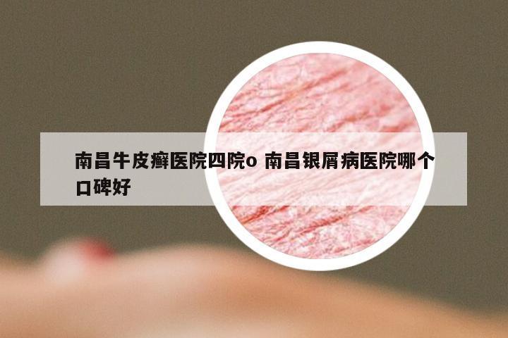 南昌牛皮癣医院四院o 南昌银屑病医院哪个口碑好