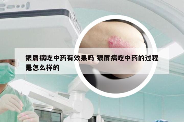 银屑病吃中药有效果吗 银屑病吃中药的过程是怎么样的