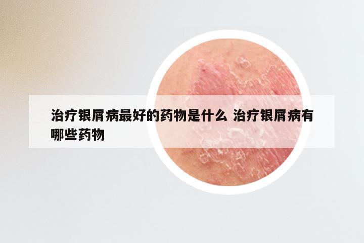 治疗银屑病最好的药物是什么 治疗银屑病有哪些药物