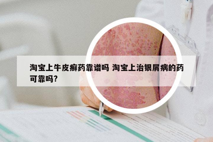 淘宝上牛皮癣药靠谱吗 淘宝上治银屑病的药可靠吗?