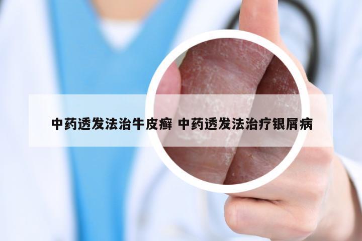 中药透发法治牛皮癣 中药透发法治疗银屑病