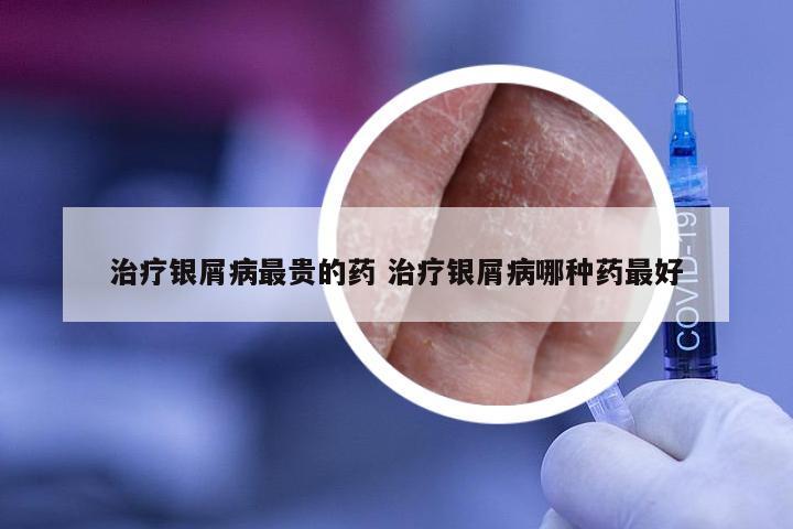 治疗银屑病最贵的药 治疗银屑病哪种药最好