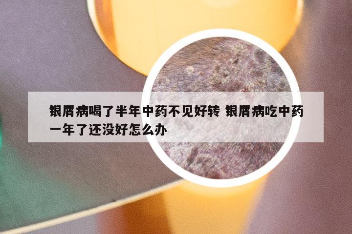 银屑病喝了半年中药不见好转 银屑病吃中药一年了还没好怎么办
