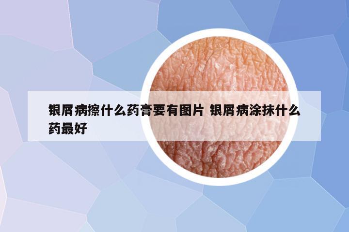 银屑病擦什么药膏要有图片 银屑病涂抹什么药最好