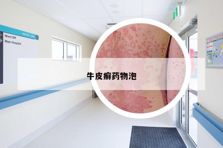 牛皮癣药物泡