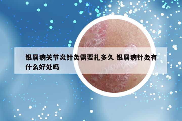 银屑病关节炎针灸需要扎多久 银屑病针灸有什么好处吗