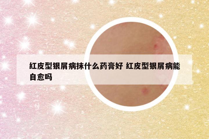 红皮型银屑病抹什么药膏好 红皮型银屑病能自愈吗