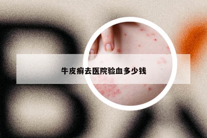 牛皮癣去医院验血多少钱