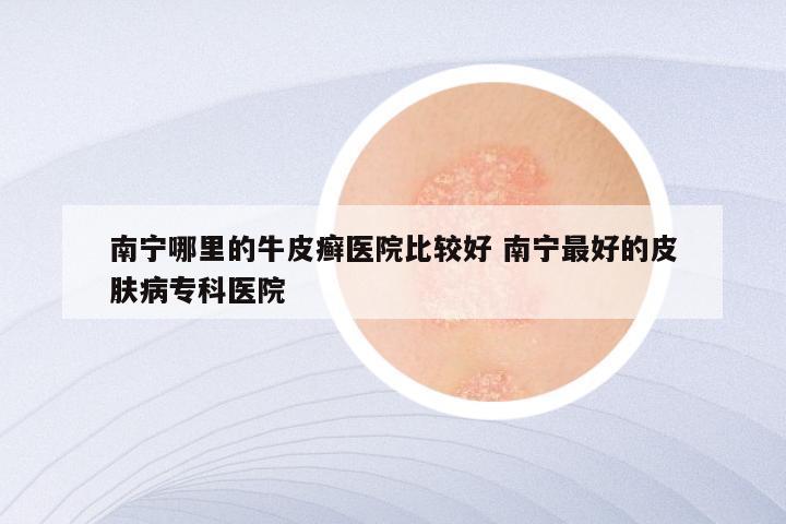 南宁哪里的牛皮癣医院比较好 南宁最好的皮肤病专科医院