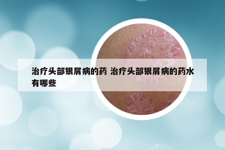 治疗头部银屑病的药 治疗头部银屑病的药水有哪些