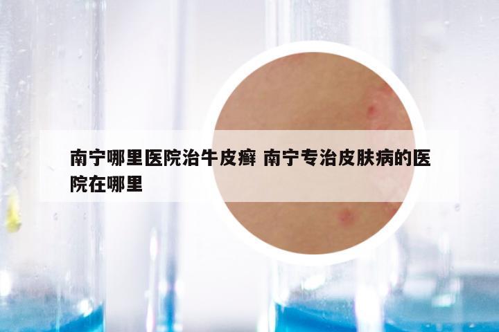 南宁哪里医院治牛皮癣 南宁专治皮肤病的医院在哪里