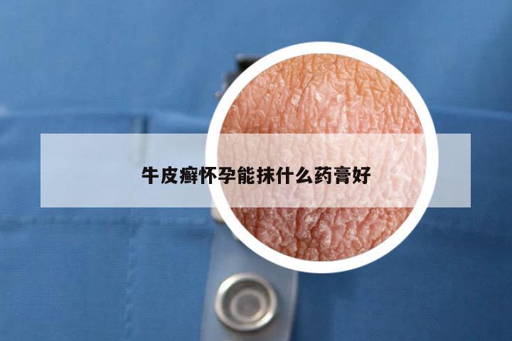 牛皮癣怀孕能抹什么药膏好