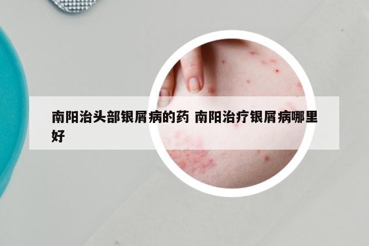 南阳治头部银屑病的药 南阳治疗银屑病哪里好