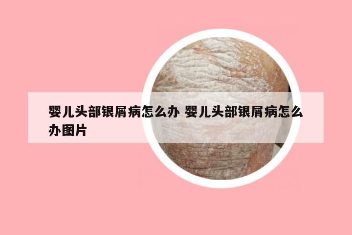 婴儿头部银屑病怎么办 婴儿头部银屑病怎么办图片