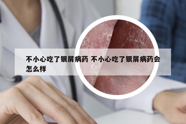 不小心吃了银屑病药 不小心吃了银屑病药会怎么样