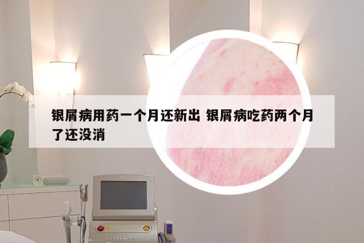 银屑病用药一个月还新出 银屑病吃药两个月了还没消