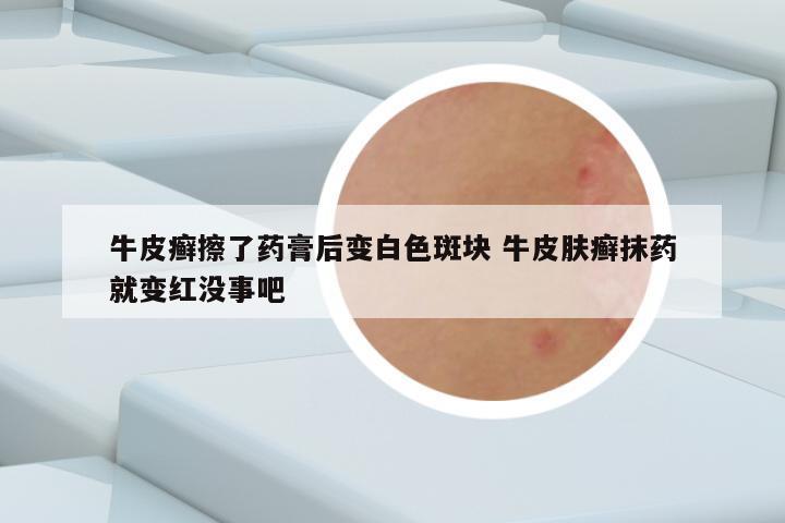 牛皮癣擦了药膏后变白色斑块 牛皮肤癣抹药就变红没事吧