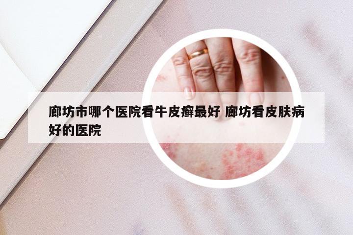 廊坊市哪个医院看牛皮癣最好 廊坊看皮肤病好的医院