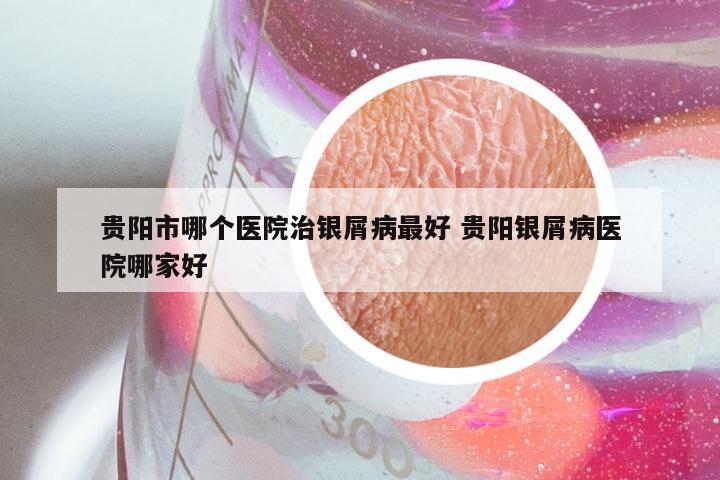 贵阳市哪个医院治银屑病最好 贵阳银屑病医院哪家好