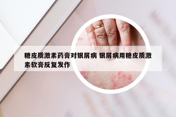 糖皮质激素药膏对银屑病 银屑病用糖皮质激素软膏反复发作