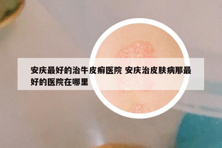 安庆最好的治牛皮癣医院 安庆治皮肤病那最好的医院在哪里