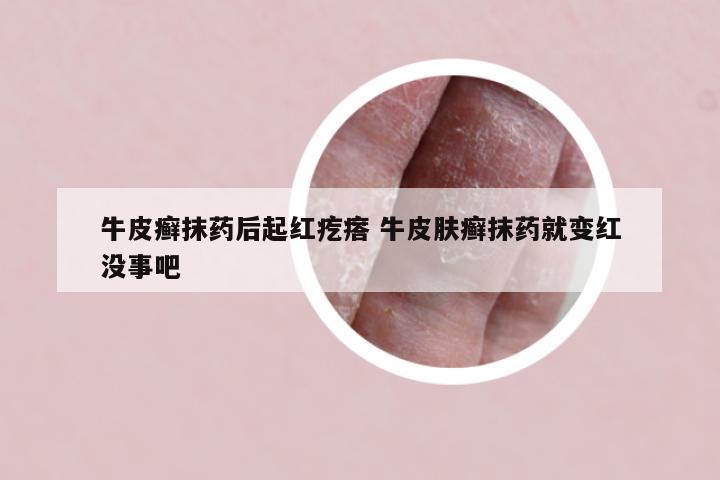 牛皮癣抹药后起红疙瘩 牛皮肤癣抹药就变红没事吧