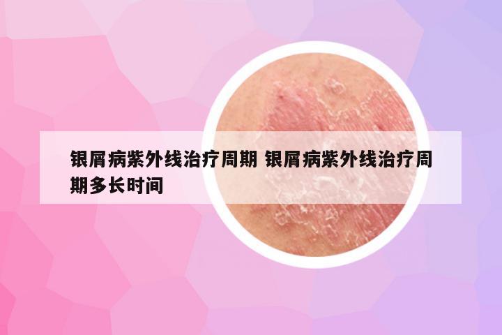 银屑病紫外线治疗周期 银屑病紫外线治疗周期多长时间