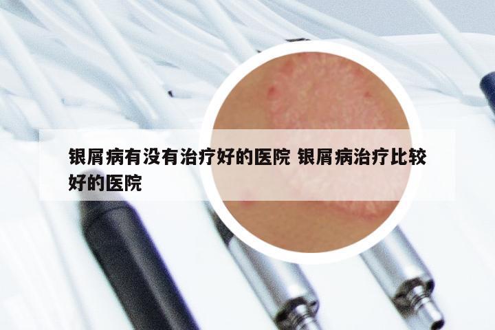 银屑病有没有治疗好的医院 银屑病治疗比较好的医院