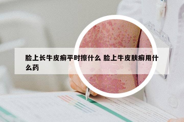 脸上长牛皮癣平时擦什么 脸上牛皮肤癣用什么药