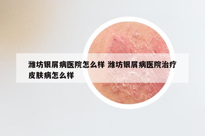 潍坊银屑病医院怎么样 潍坊银屑病医院治疗皮肤病怎么样