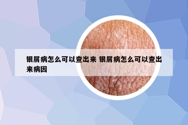 银屑病怎么可以查出来 银屑病怎么可以查出来病因