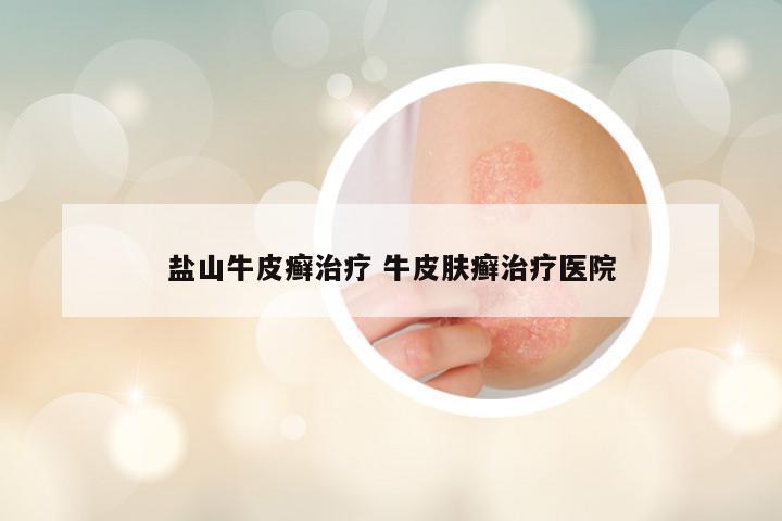 盐山牛皮癣治疗 牛皮肤癣治疗医院