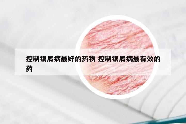 控制银屑病最好的药物 控制银屑病最有效的药