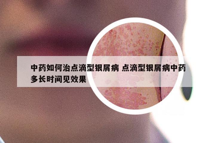 中药如何治点滴型银屑病 点滴型银屑病中药多长时间见效果