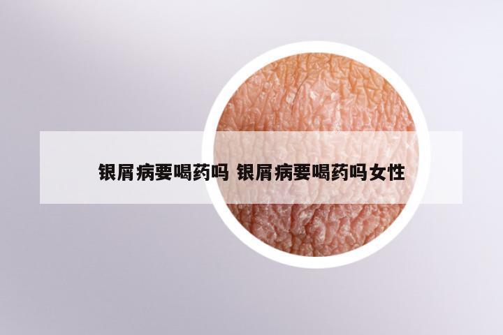 银屑病要喝药吗 银屑病要喝药吗女性