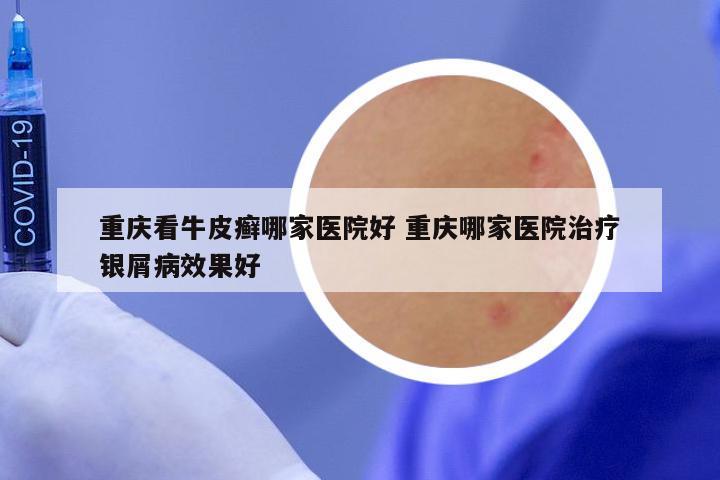 重庆看牛皮癣哪家医院好 重庆哪家医院治疗银屑病效果好