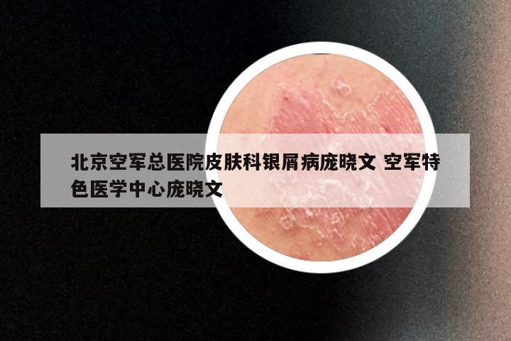 北京空军总医院皮肤科银屑病庞晓文 空军特色医学中心庞晓文