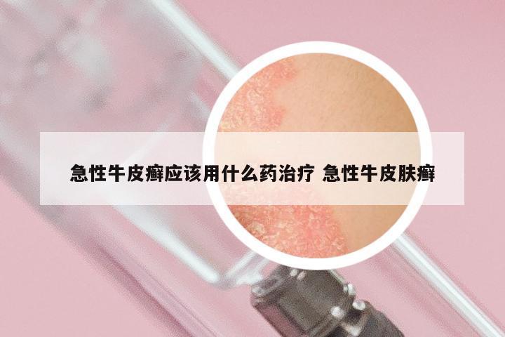 急性牛皮癣应该用什么药治疗 急性牛皮肤癣