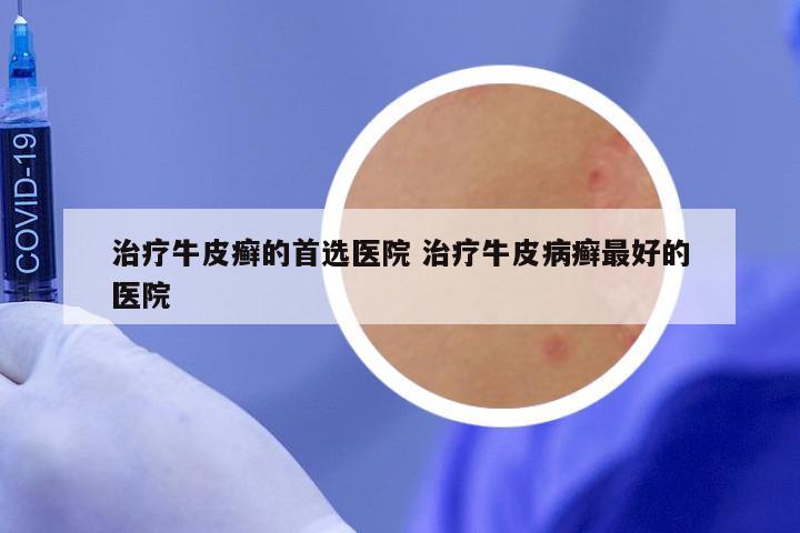 治疗牛皮癣的首选医院 治疗牛皮病癣最好的医院