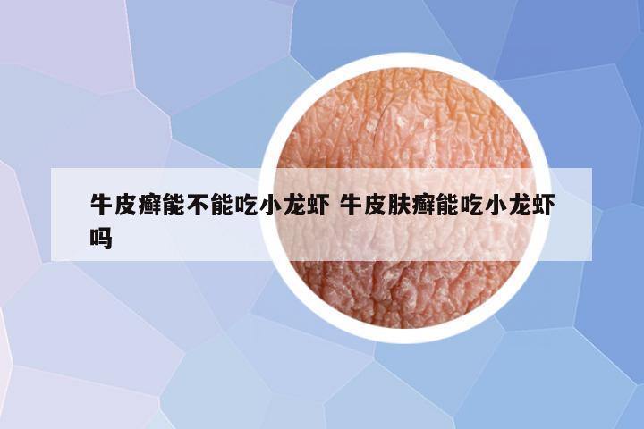 牛皮癣能不能吃小龙虾 牛皮肤癣能吃小龙虾吗