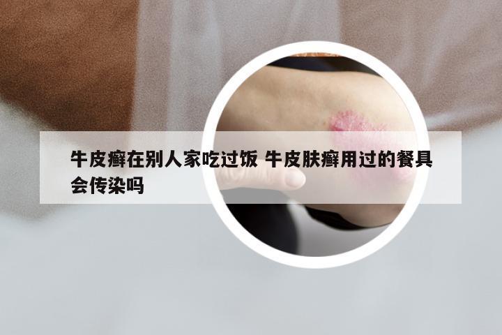 牛皮癣在别人家吃过饭 牛皮肤癣用过的餐具会传染吗