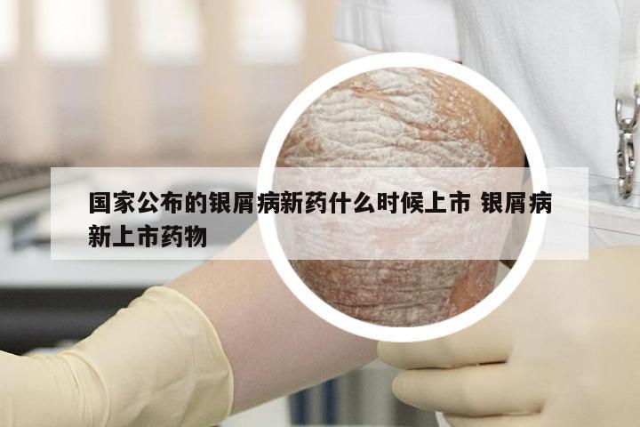 国家公布的银屑病新药什么时候上市 银屑病新上市药物