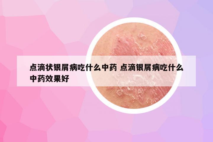 点滴状银屑病吃什么中药 点滴银屑病吃什么中药效果好